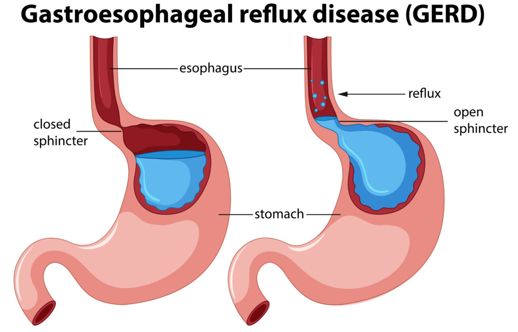 Gastroesophageal Reflux Illness (GERD)